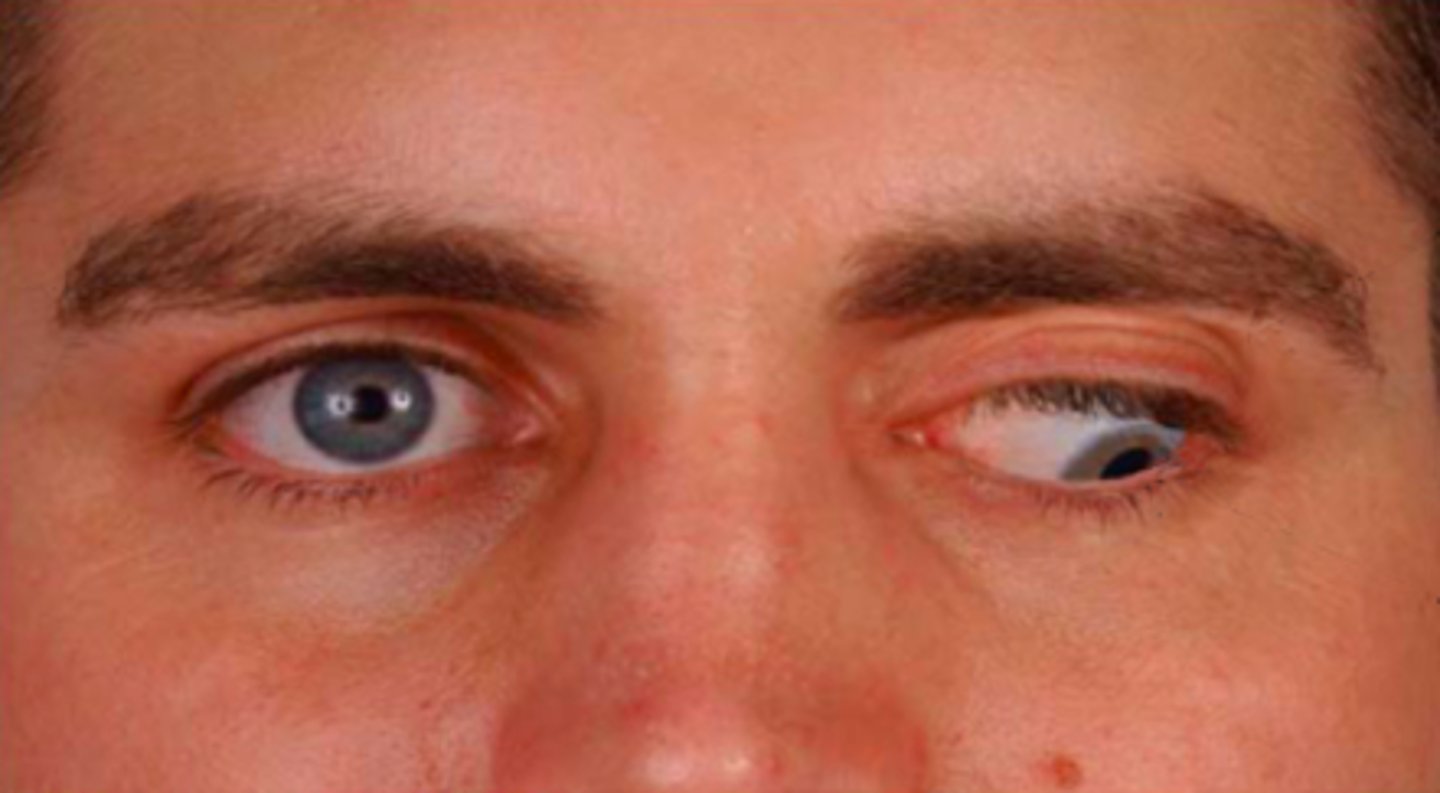 <p>patient presents with the following eye movement. You recognize that this is __________ nerve palsey</p>