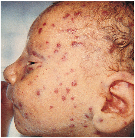 <p>Cytomegalovirus (CMV) Infection</p><p>Leading infectious cause of hearing impairment and cognitive delay in infants and children; there is no effective and safe immunization against CMV</p><p>Transmitted during the perinatal period</p><p>Newborns with congenital CMV may experience<span style="color: yellow"><strong> intrauterine growth restriction, microcephaly, hepatosplenomegaly, thrombocytopenia, and/or jaundice at birth. </strong></span></p><p><span style="color: yellow"><strong>Hearing impairment may not be apparent until after the first year of life</strong></span> </p><p>Approximately 20 to 30% of symptomatic infants will die of <span style="color: yellow"><strong>DIC and liver dysfunction</strong></span></p>