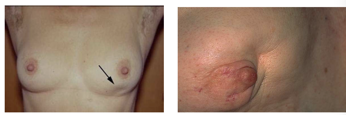 <p>abnormal </p><ul><li><p>dimpling </p></li><li><p>retractions </p></li><li><p>these are both breast cancers and tumors </p></li></ul><p></p>