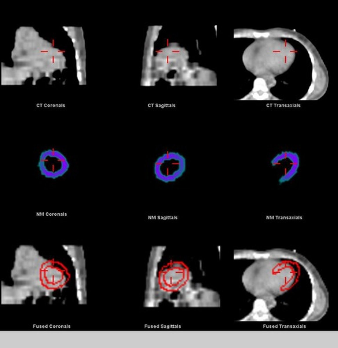 <p>To create a noise-free attenuation correction map for SPECT reconstruction.</p>
