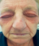 <p>COMMON DISORDERS SEEN WITH AGING</p><p>is an unsightly skin condition characterized by <span style="color: red;">yellow, waxy crusts that can be either dry or moist</span></p>