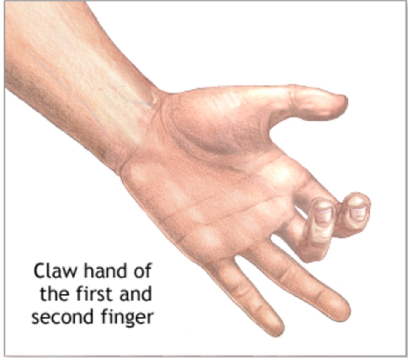 <p>common cause is capral tunnel syndrome</p><p>pain and tingling or numbness/anesthesia in the cutaneous portion</p>