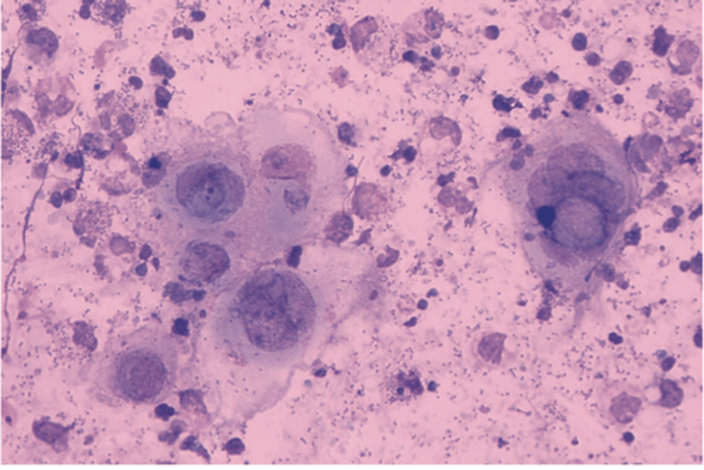 <p>Multinucleated giant cells</p>