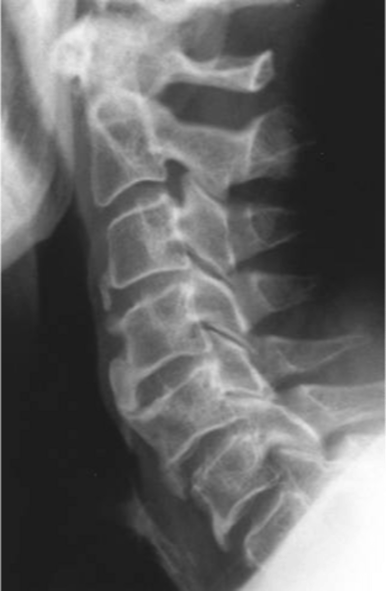 <p>State the target sites of diffuse idiopathic skeletal hyperostosis (DISH)</p>