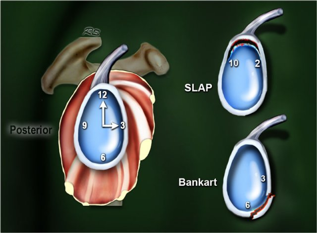 <p>anterior-inferior portion of glenoid labrum </p>