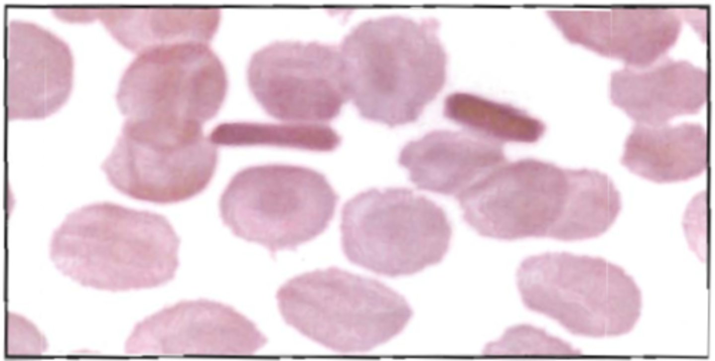 <p>88. With this blood picture, an additional test indicated is:</p><p>See BOC pg 159</p><p>A. alkali denaturation</p><p>B. alkaline phosphatase stain</p><p>C. peroxidase stain</p><p>D. hemoglobin electrophoresis</p>