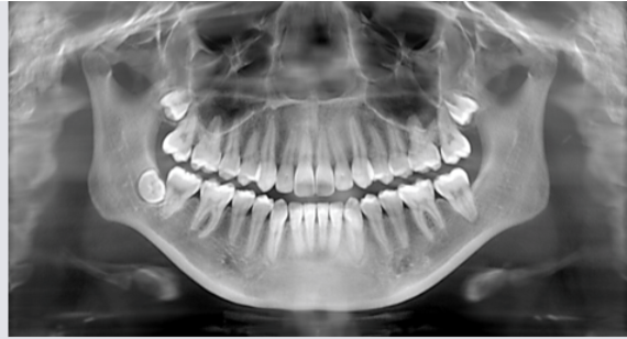 <p>what does panoramic xray show </p>