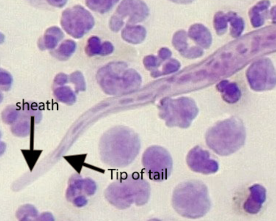 <p>caused by Loa-loa (African eye worm), assoc’d Calabar swellings</p><p>v = <span style="color: red">deerflies </span>in West &amp; Central Africa; L3 larve (IS)</p><p>dx: MF found in CSF, urine, sputum, blood, feeling across nose bridge, crosses eyeball</p>