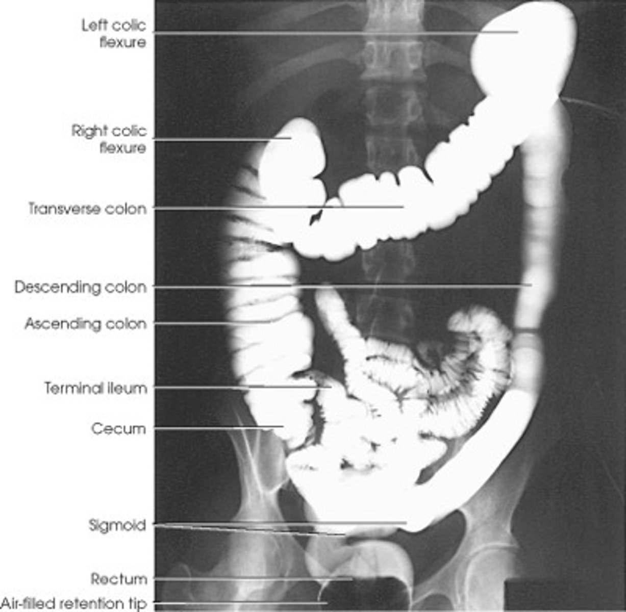 <p>radiopaque contrast media administered</p><p>-GI tract (via swallow or enema)</p><p>-Urinary tract (urography, IV pyelogram/IVP) - inject contrast into the blood vessels, give time and it will pass to designated area to enhance visibility of structures in imaging. </p><p>-Blood Vessels (angiography)</p><p>-Vertebral Column (myelography) - contrast to CSF to light up column</p>