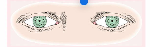 <p>Also known as pinpoint pupils,  is characterized by constricted and fixed pupils possibly a result of narcotic drugs or brain damage.</p>