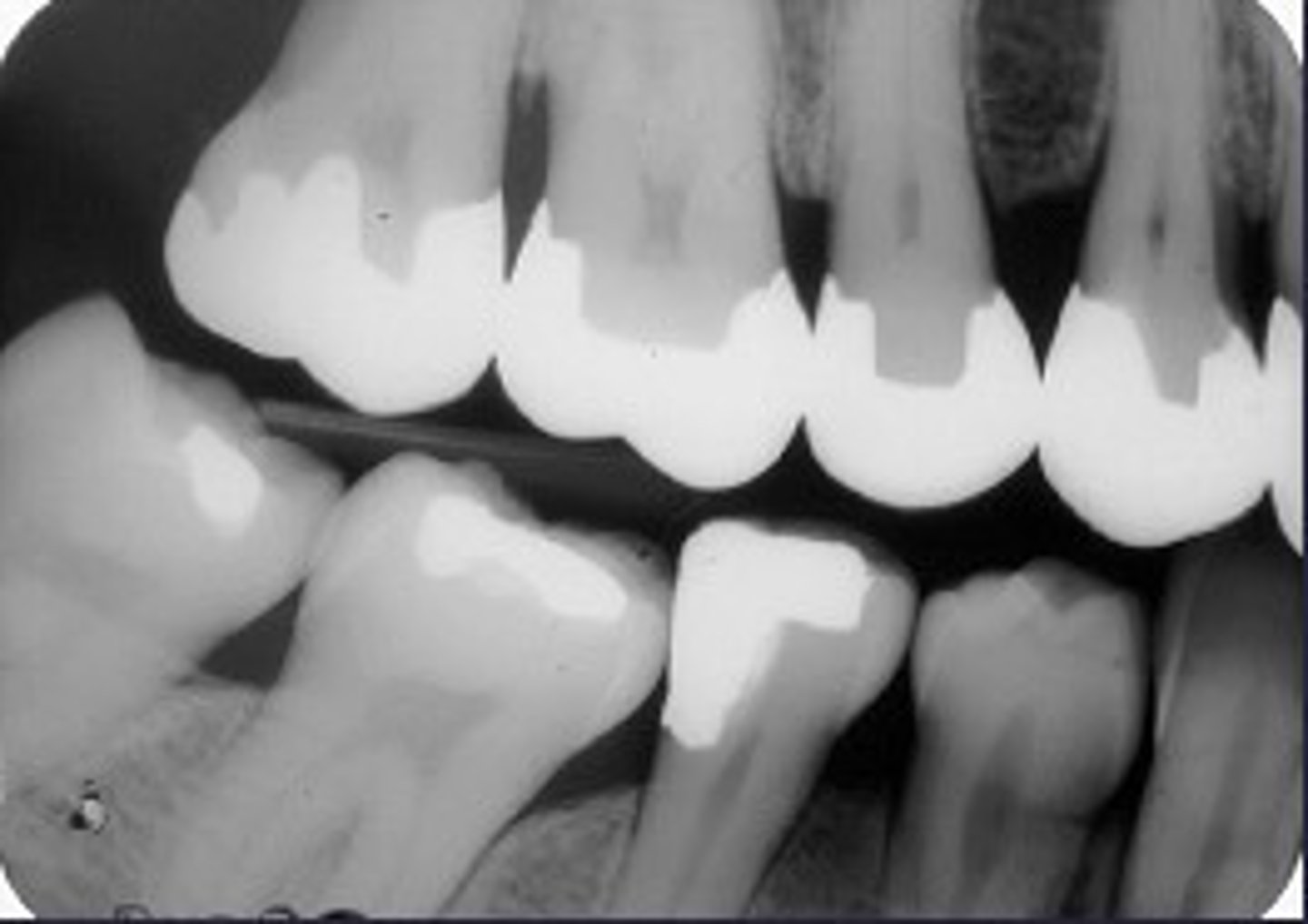 <p>Identify restoration type</p>
