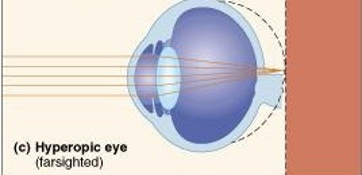 <p>hyperopic, with a visual acuity of less than 20/400 (peripheral vision fully develop at birth)</p>