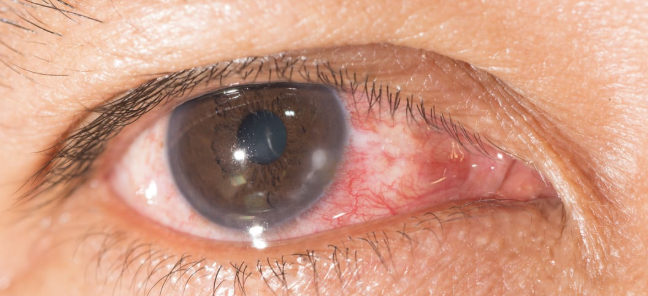 <p>One of the 6 Corneal Abnormalities</p><ul><li><p>Inflammation of the cornea, which can be infectious (bacterial, viral, fungal) or non-infectious (due to trauma, dry eyes, or improper use of contact lenses)</p></li><li><p>Accompanied by eye redness, pain, decreased vision, discharge, and photophobia</p></li></ul><p></p>