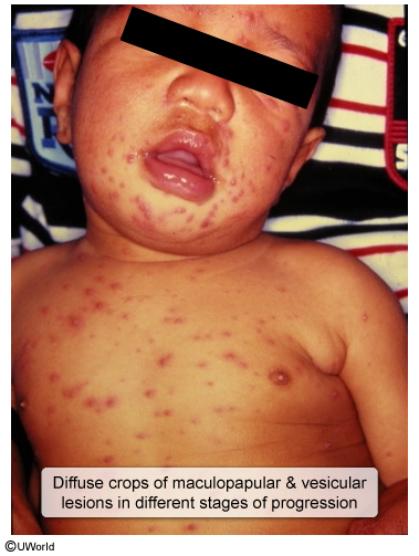 <p>cheeks, chest → abdomen, back, extremeties</p><p>fever, runny nose</p>