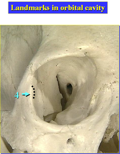 small elevation/bump on the orbital surface of the zygomatic bone, located just within the lateral orbital margin at its midpoint; serves as the attachment site for several structures