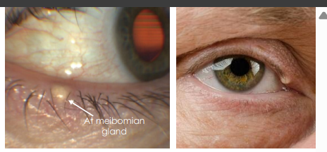 <ol><li><p>Meibomian gland cysts are small, focal, subcutaneous nodule with minimal to no inflammation </p></li><li><p>• Extrameibomian gland cyst (Zeis) grow larger, smooth, y<strong><u>ellow, opaque, “cheesy”, freely movable,</u></strong> and can rupture causing inflammation.</p></li></ol><p></p>