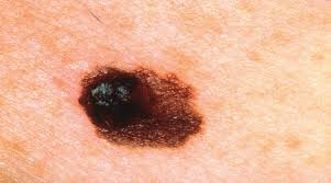 <p>Most deadly skin cancer, cancer of melanocytes, metastasizes rapidly to lymph and blood vessels, detection using ABCD rule</p>