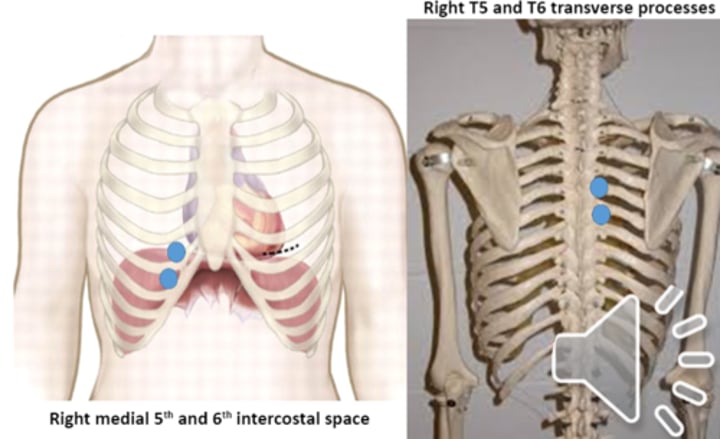 <p>anterior point: right 5th and 6th intercostal spaces<br>posterior point: right T5 and T6 transverse processes</p>