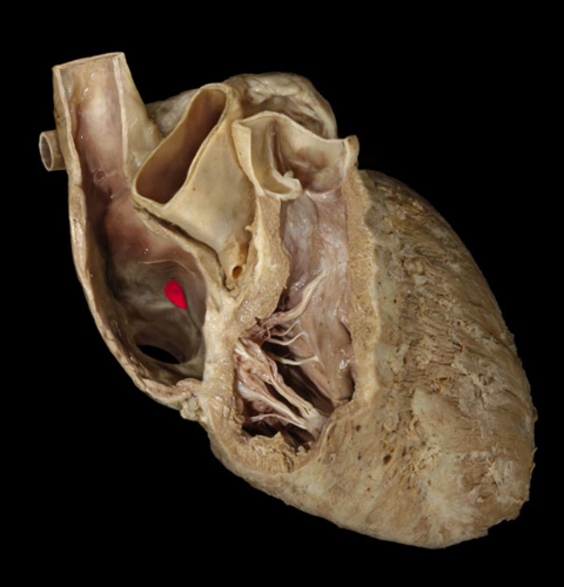 <p>depression</p><p>in R atrium, pinto bean buried in R atrium</p><p>H5</p><p>24</p>