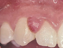 <p>an example of a<span style="color: red;"> tumescence</span></p><p>can occur<span style="color: red;"> </span>anywhere in the oral mucosa or on the skin</p><p>an <span style="color: red;">overgrowth of young, highly vascular granulation tissue</span></p><ul><li><p><strong>cause:</strong></p><ul><li><p>reaction to <span style="color: red;">chronic irritation or dental plaque</span></p></li><li><p>pregnancy or puberty, <span style="color: red;">hormonal changes</span> may cause exaggerated tissue reactions</p></li></ul></li></ul><ul><li><p><strong>management:</strong></p><ul><li><p>dentist must identify and <span style="color: red;">resolve the underlying cause</span> (ex: iatrogenic restoration, foreign body, or dental infection)</p></li></ul></li></ul><p></p><p><em>[ note: misnomer – does not produce pus and is not a true granuloma ]</em></p>