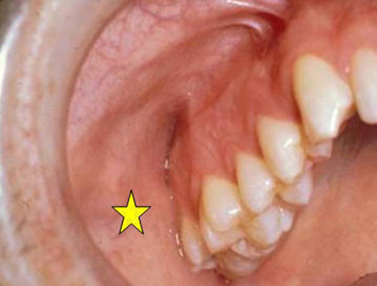 <p>Between teeth and cheeks</p><p>- Houses parotid duct</p>