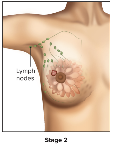 <ul><li><p>Tumor is larger and more invasive to surrounding tissues</p></li><li><p>Still entirely within its originating tissue though</p></li><li><p>Lymph nodes may have cancer cells in them</p></li></ul>