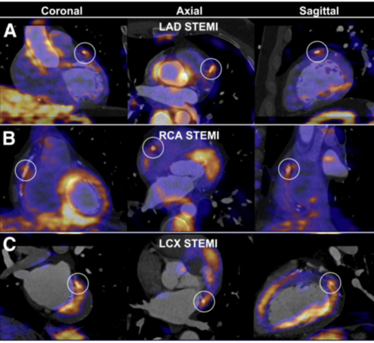 <p>Radioactive substance "tags" or "labels" the RBCs &amp; a gamma ray camera takes pics of the heart as the tagged RBCs circulate</p><p>-Looks at flow in the heart (how effective is the pump)</p>