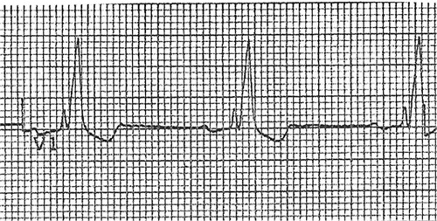 <p>Which Arrythmia is this?</p>