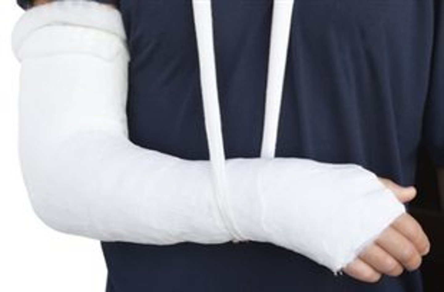 <p>a cast</p>