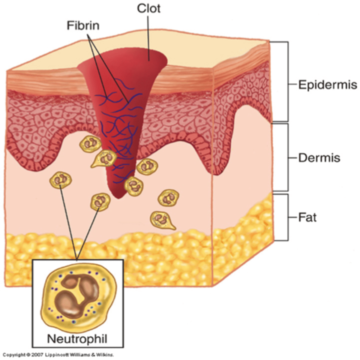 <p>The initial phase of wound healing; includes blood clotting and invasion of WBCs</p>