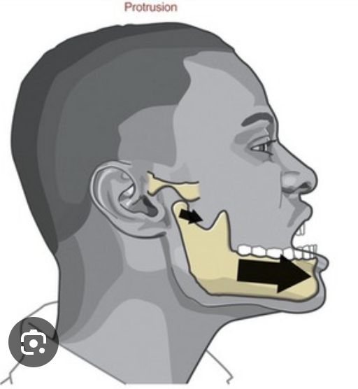 <p>when the mandible moves forward from the normal bite position - guided by the anterior teeth and also protects the posterior teeth from wear&nbsp;</p>