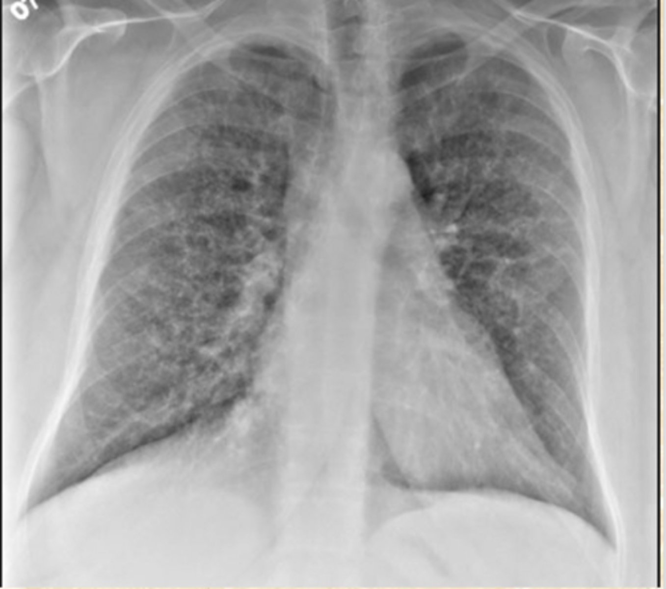 <p>What does this CXR show?</p>