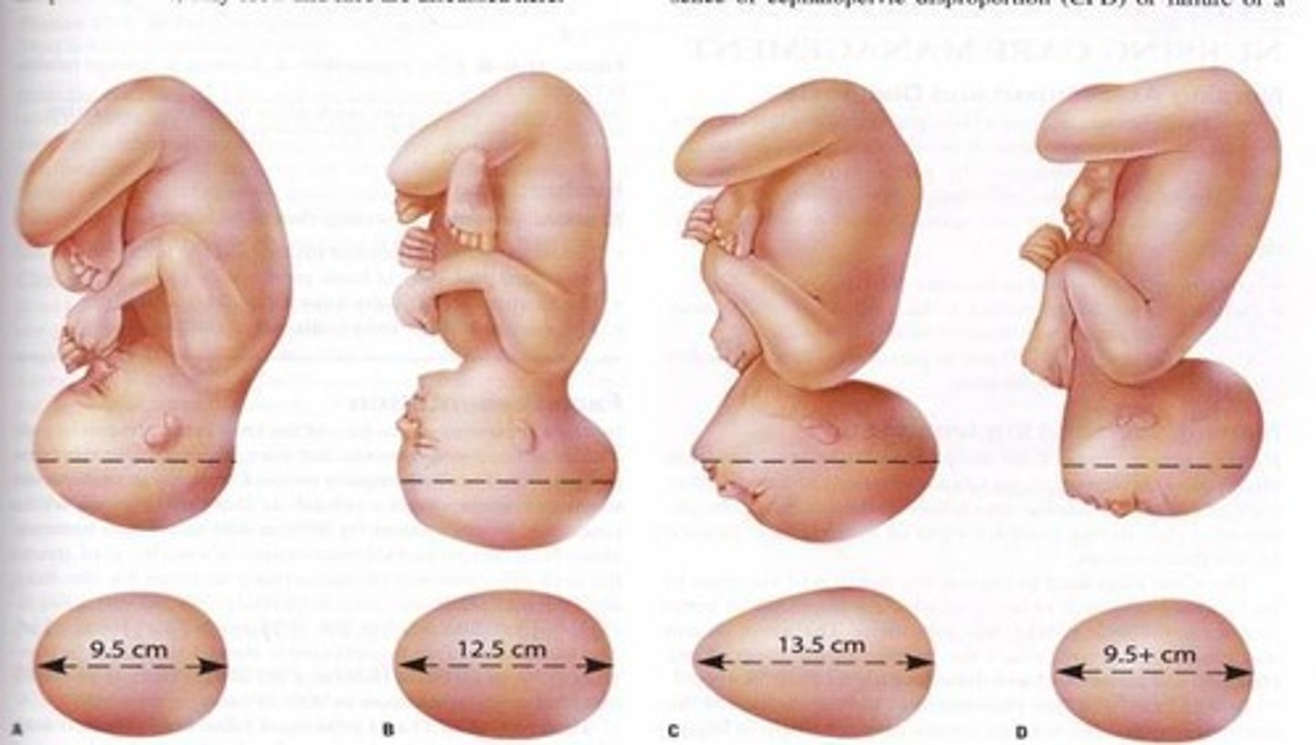 <p>A condition where the fetal head is too large to pass through the mother's pelvis.</p>