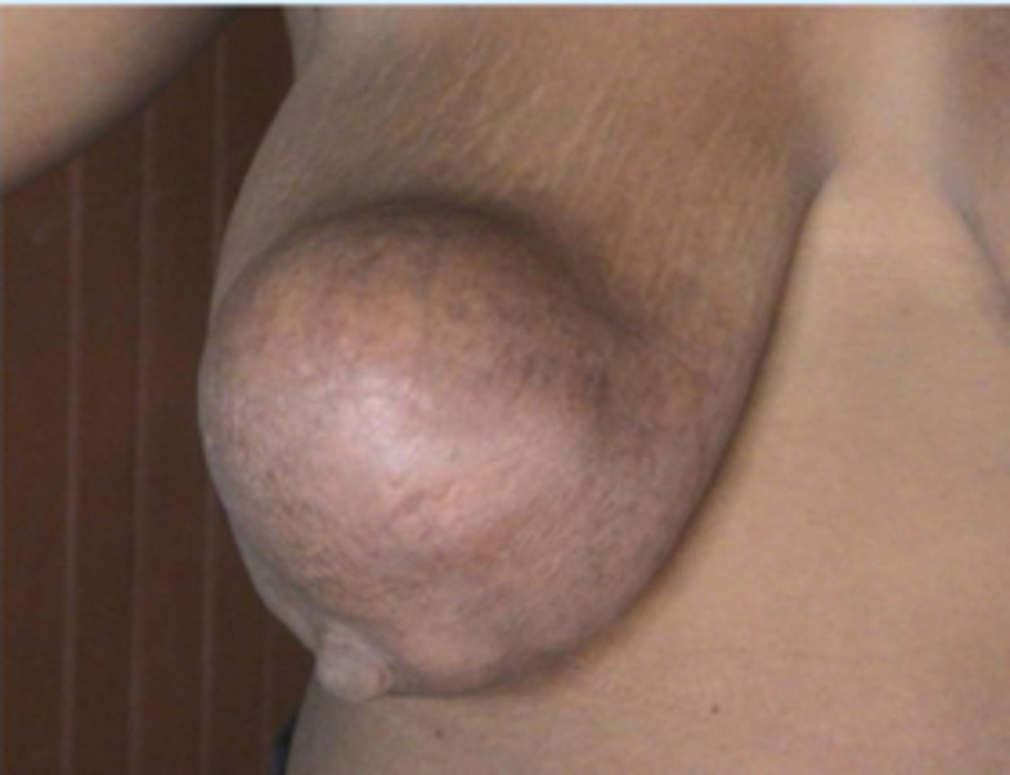 <p>Define Condition:</p><p>Cystic dilation of a duct filled with thick, milky fluid due to ductal obstruction (inflammation, hyperplasia, or neoplasia)</p><p>-Hx: During or After Lactation</p><p>-Sx/PE: Multiple Cysts present</p><p>-Prog: Secondary Infex (Mastitis/Abscess)</p><p>-Tx: FNA (CURATIVE)</p><p>&gt; If bloody/residual mass ==&gt; Excisional Biopsy</p>