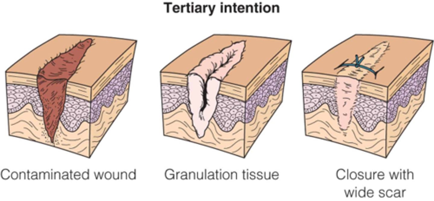 <p>when a wound is allowed to remain open for a time and then closed, allowing for debridement and other wound care - to reduce bacterial counts prior to closure</p>