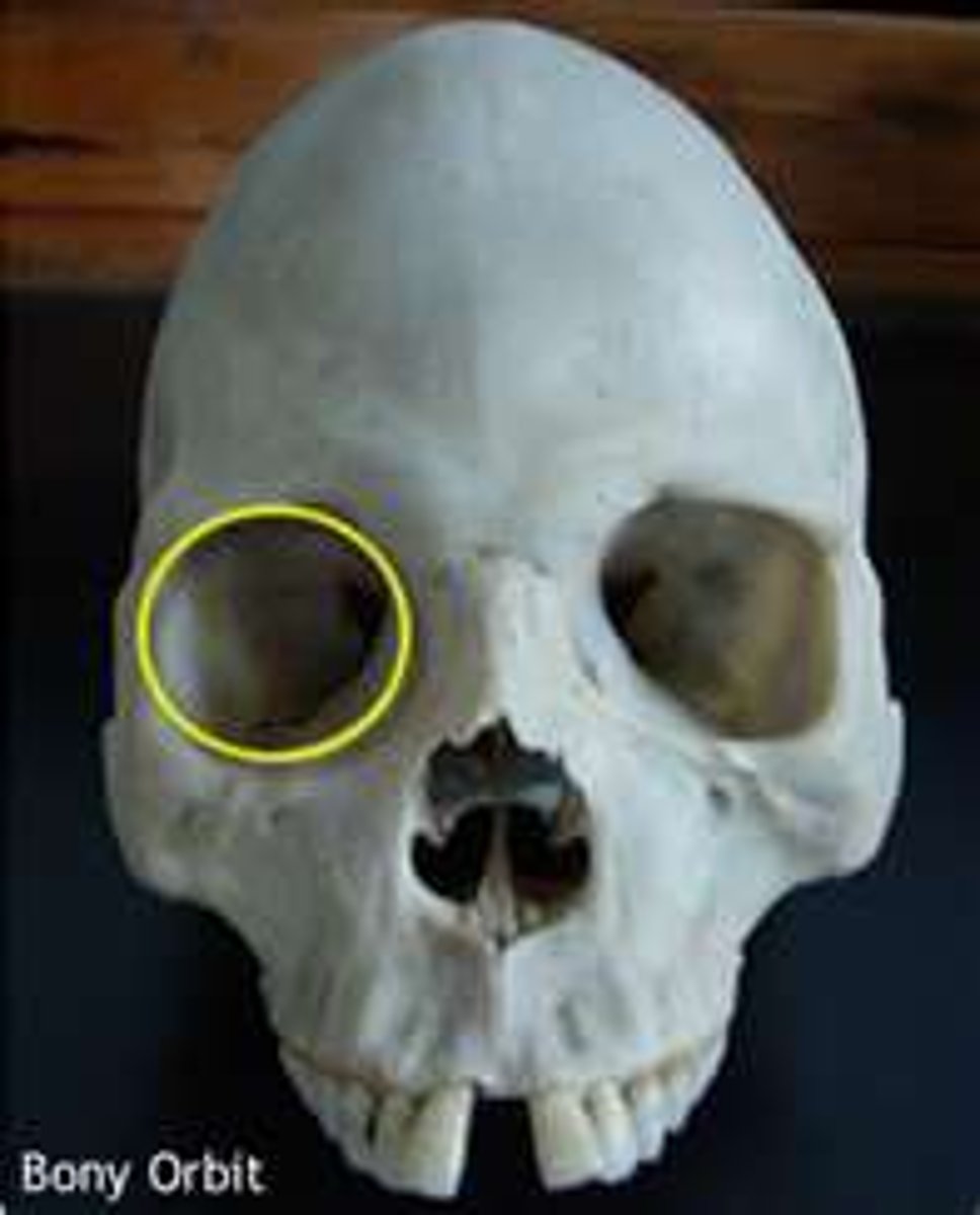 <p>margin orbital fractures</p>