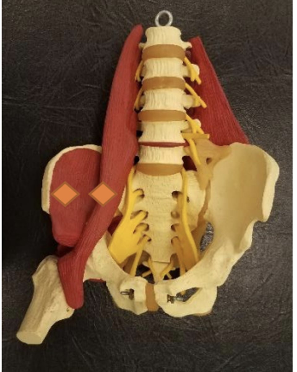 <p>1/3 distance from ASIS to midline (closer to ASIS than psoas)</p>