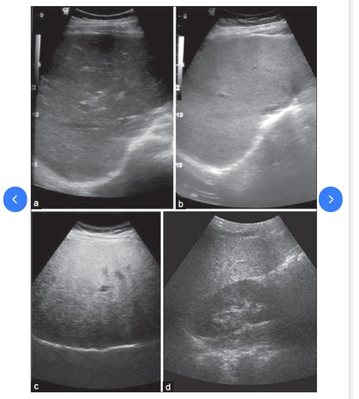 <p>Grades of fatty liver on visual analysis. Ultrasound image shows (a) Normal liver echogenicity (b) Grade 1 fatty liver with increased liver echogenicity (c) Grade 2 fatty liver with the echogenic liver obscuring the echogenic walls of the portal venous branches (d) Grade 3 fatty liver in which the diaphragmatic outline is obscured</p>