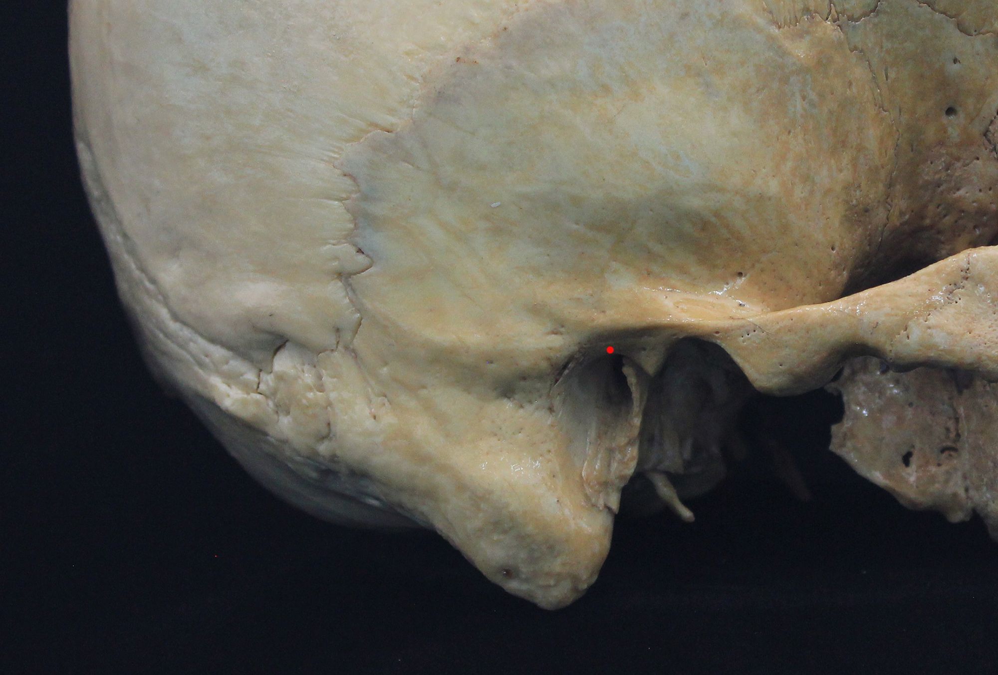 <p>Uppermost point on margin of external acoustic meatus</p>