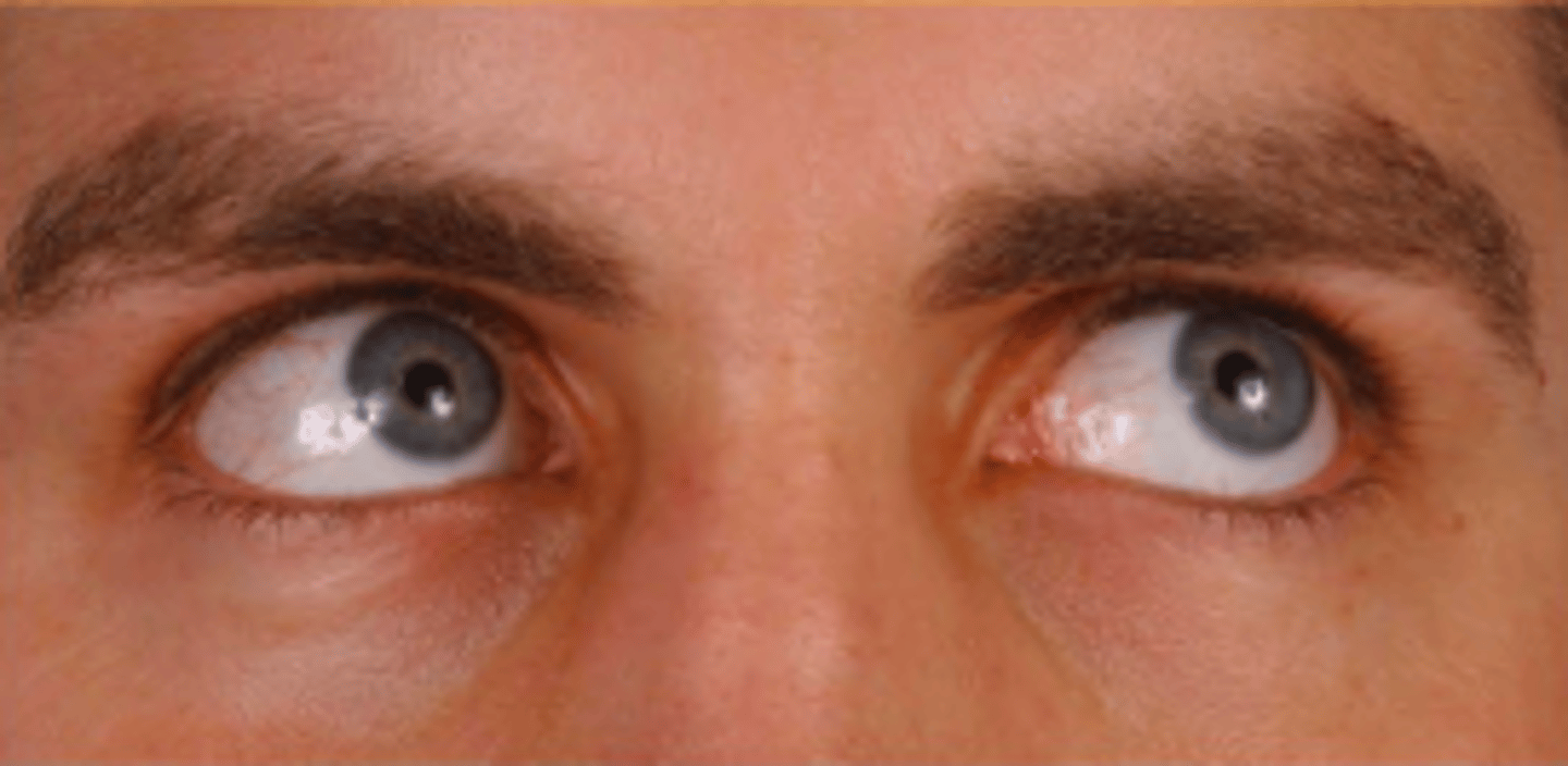<p>left abduction, right adduction</p>