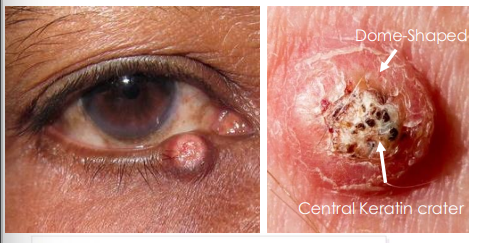 <p><strong><u>• Dome-shaped with keratin filled central crater</u></strong></p><p><strong><u>• Rapid onset </u></strong>and grows over weeks and may spontaneously regress over months leaving a scar</p><p><strong><u>• Considered as a low-grade form of Squamous Cell Carcinoma (SCC) or precursor to SCC</u></strong></p>