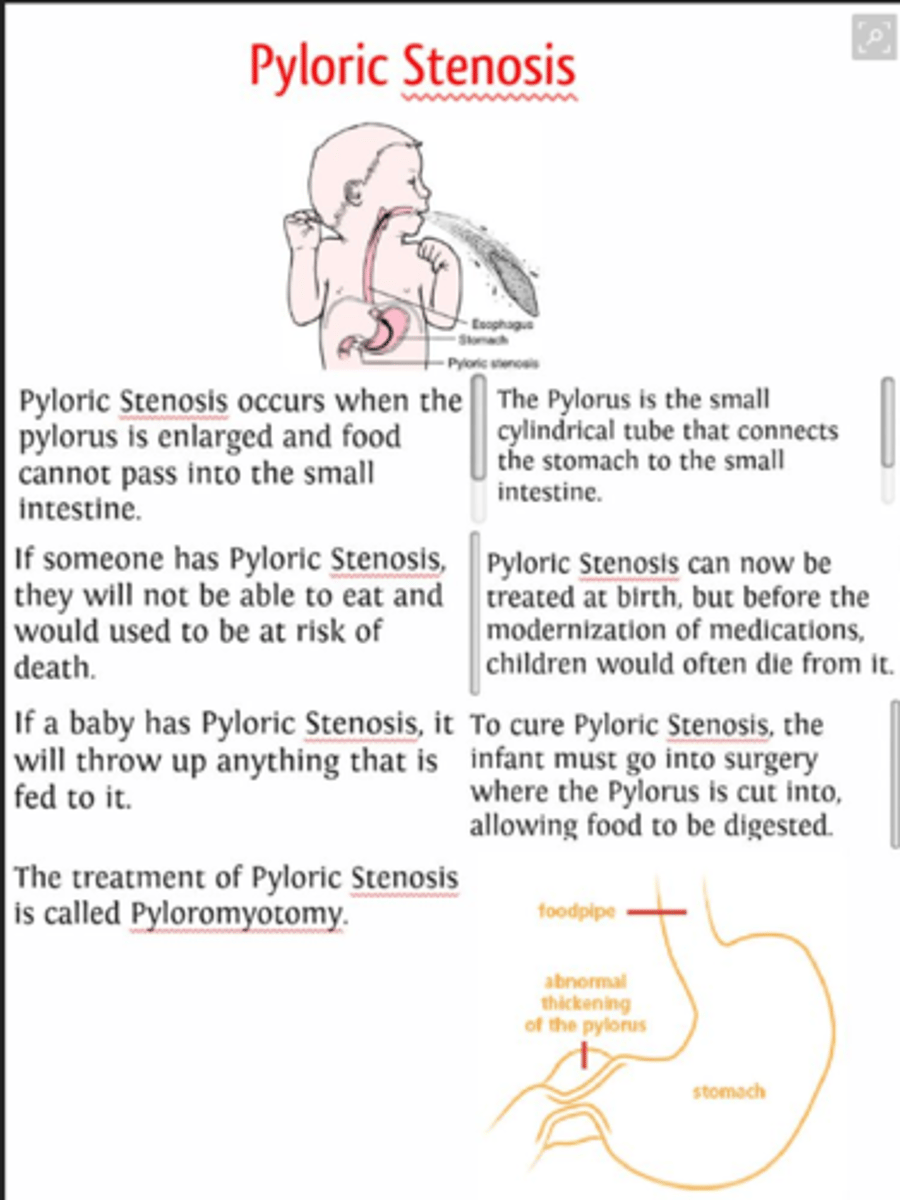 <p>A</p><p>Significant peristalsis, together with projectile vomiting, in the newborn suggests pyloric stenosis. After feeding, pronounced peristaltic waves cross from left to right, leading to projectile vomiting. One can also palpate an olive-sized mass in the right upper quadrant.</p>