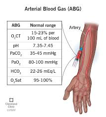 <p>ABGs</p><p><span style="color: purple"><em>(Arterial Blood Gases: xét nghiệm khí máu ĐM) </em></span></p>
