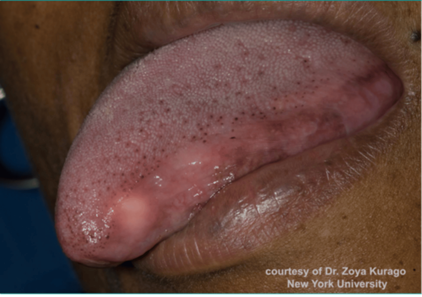 <p>Patient presents with a yellowish growth on the dorsolateral tongue surface. Histopathology showed Abundant pale, eosinophilic granular cytoplasm and pseudoepitheliomatous hyperplasia. What do you suspect?</p>