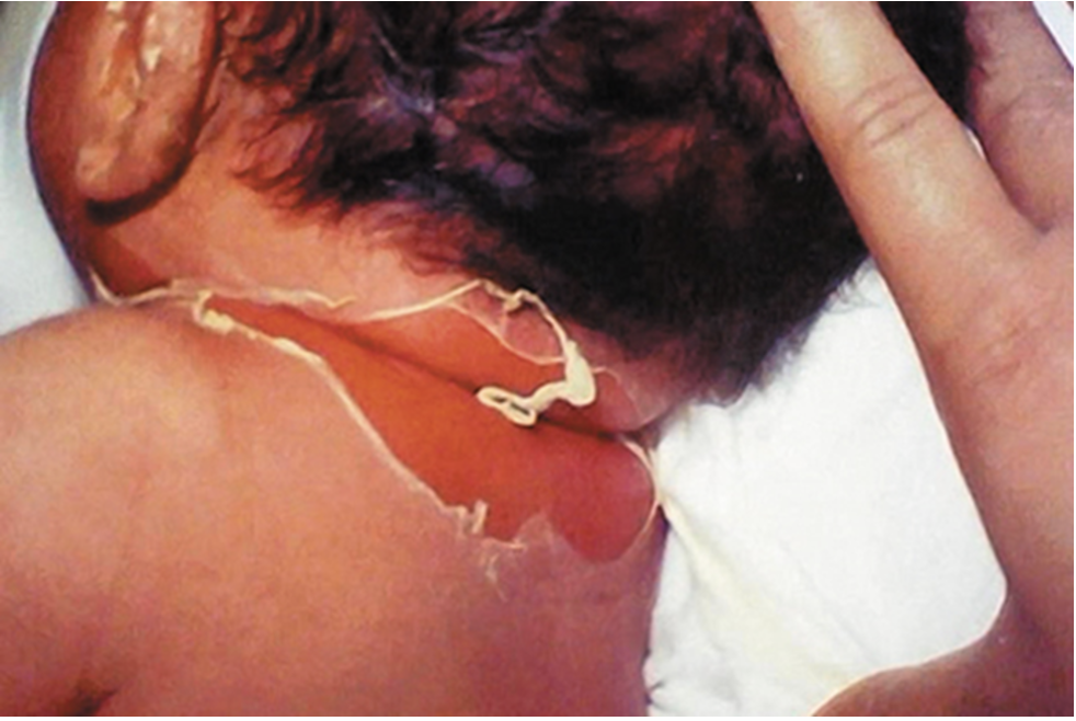 <p>what is the name of the infection caused by<em> Staphylococcus aureus</em>&nbsp;that is depicted in the image?</p>