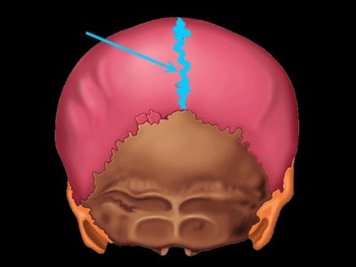 <p>between parietal bones</p>