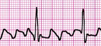 <p>Which cardiac rhythm is shown?</p>