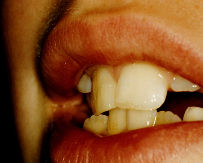 <p>contour matches the tooth well - with an irregular surface as teeth are not always dead flat&nbsp;</p>