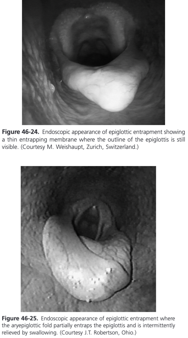 <ul><li><p><span>Epiglottis is covered with a fold of mucosa so the crenate margins of the epiglottis and the dorsal epiglottis vessels are obscured</span></p></li><li><p><span>Entrapping membrane may be asymmetric and/or entrap the epiglottis only intermittently, being relieved when the horse swallows, but in most cases it is persistent</span></p></li><li><p><span>Most epiglottic entrapments are persistent (97%), most are thick (98%), most are wide (97%), and 45% are ulcerated</span></p></li><li><p><span>Horses with epiglottic entrapment may also suffer from varying degrees of epiglottic hypoplasia and/or flaccidity</span></p><ul><li><p><span>On endoscopic examination, 31-36% of horses with entrapment appear to have epiglottic hypoplasia</span></p></li></ul></li><li><p><span>A lateral laryngeal radiograph allows accurate measurement of thyroepiglottic length and information about epiglottic thickness and contour</span></p></li><li><p><span>In one study of Thoroughbreds with epiglottic entrapment, the thyroepiglottic length was 6.59 cm and in another study it was 7.28 cm</span></p><ul><li><p><span>These measurements were significantly smaller than those found in normal Thoroughbreds without entrapment which in two studies was 8.76 cm and 8.56 cm</span></p></li></ul></li><li><p><span>The thyroepiglottic length in Standardbreds with entrapment was 7.21 cm also significantly less than the length of 8.74 cm found in normal Standardbreds</span></p></li><li><p><span>Among Standardbred and Thoroughbred horses with epiglottic entrapment, those with apparent epiglottic hypoplasia had significantly shorter thyroepiglottic lengths than horses with entrapment and a normally shaped epiglottis</span></p></li></ul>