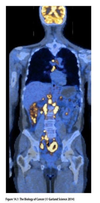 <ul><li><p class="Paragraph WhiteSpaceCollapse SCXP34147102 BCX0" style="text-align: left"><span>Whole body scan of patient with non-Hodgkin’s lymphoma (NHL)​</span></p></li><li><p class="Paragraph WhiteSpaceCollapse SCXP34147102 BCX0" style="text-align: left"><span>CT scan – Blue and PET scan​</span></p></li><li><p class="Paragraph WhiteSpaceCollapse SCXP34147102 BCX0" style="text-align: left"><span>(fluorodeoxyglucose, FDG) - yellow indicates areas of the body where the uptake of glucose is significantly increased; indicate metastases​</span></p></li><li><p class="Paragraph WhiteSpaceCollapse SCXP34147102 BCX0" style="text-align: left"><span>Increased activity in the brain is normal​</span></p></li></ul><p></p>